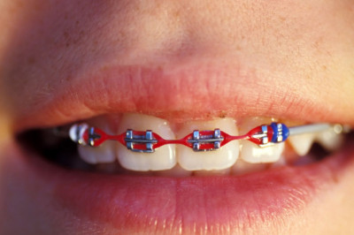 Everything you need to know about Braces | Braces And Aligners - The Dental Home