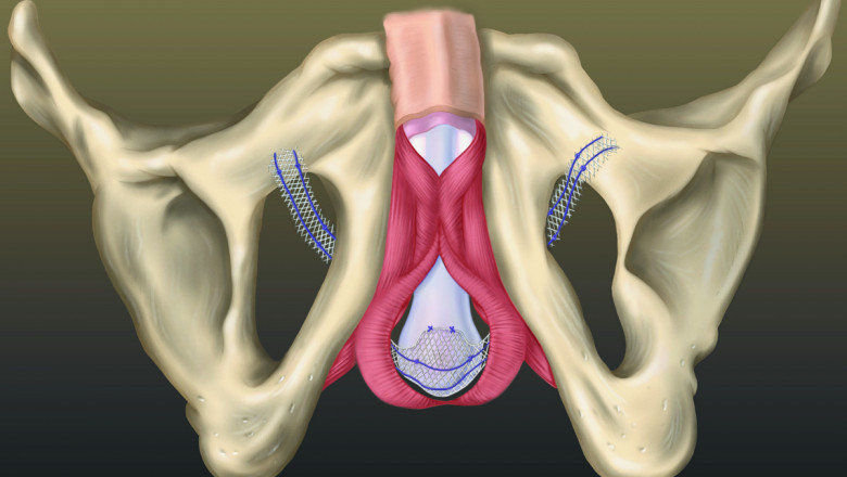 To Stop Leakage, Vaginal Slings Support And Hold The Bladder And Urethra Like A Hammock
