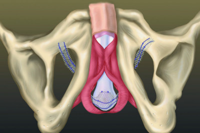 To Stop Leakage, Vaginal Slings Support And Hold The Bladder And Urethra Like A Hammock