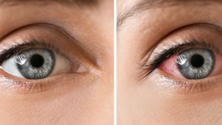 Uveitis Treatment Market Upcoming Trends, Demand, Regional Analysis and 2028 Forecast