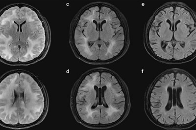 What are the types of Graft Versus Host Disease (GvHD)?