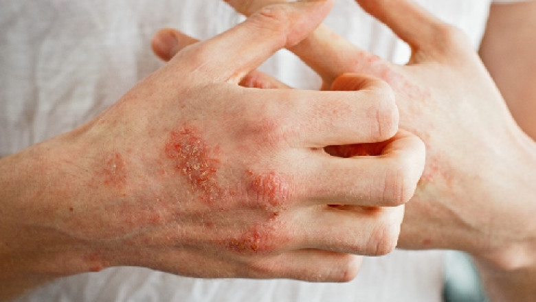 Why You Should Use Homeopathy Doctor For Skin