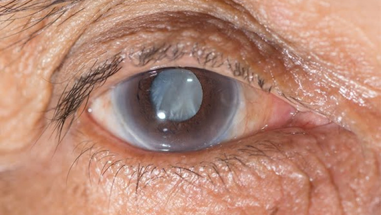 LASIK Surgery | Freedom Eye Laser