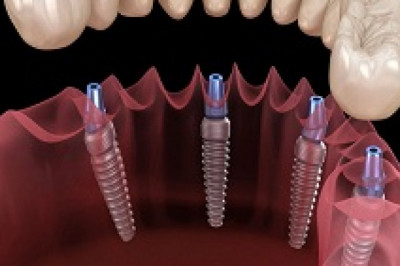 What is an All-on-4 Dental Implant Treatment?