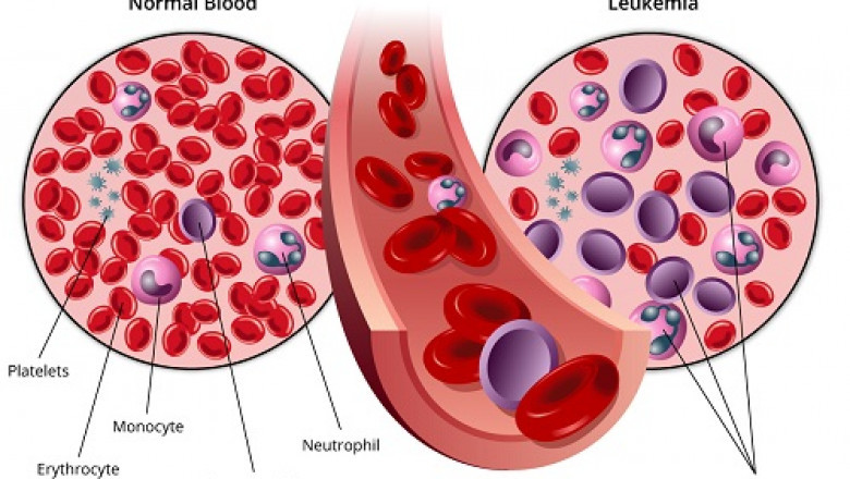 A study of the global Chronic Lymphocytic Leukemia Therapeutics Market: trends, market size, growth, opportunity, as well as forecasts for 2022-2028