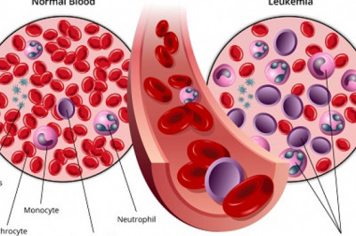A study of the global Chronic Lymphocytic Leukemia Therapeutics Market: trends, market size, growth, opportunity, as well as forecasts for 2022-2028