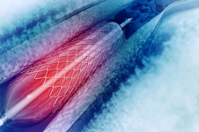 Angioplasty Balloons Opens Narrow, Blocked Arteries Using Minimally Invasive Cardiac Catheterization