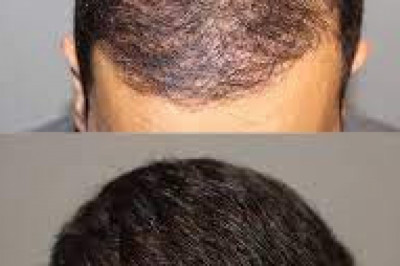 Prp Therapy For Hair Loss Treatment San Diego