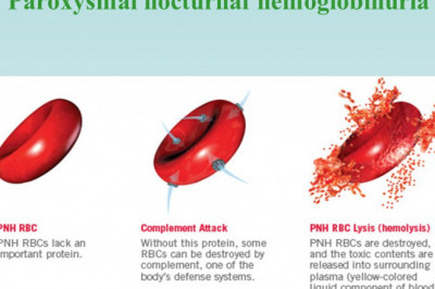 The Paroxysmal Nocturnal Hemoglobinuria Therapeutics reduces the risk of blood clotting and improves the quality of life of those suffering from PNH.