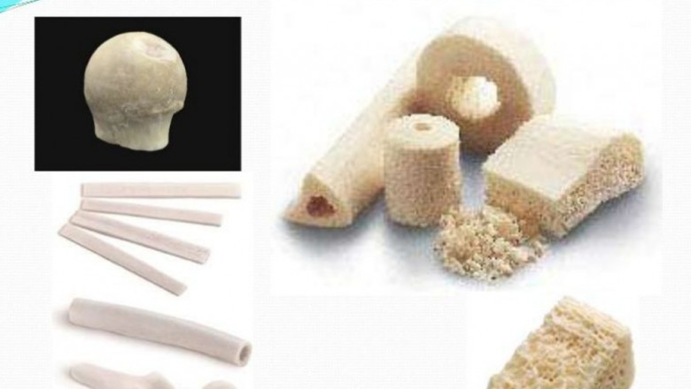 Bone Grafts Substitutes Market to Reach US$ 3.5 million by 2030