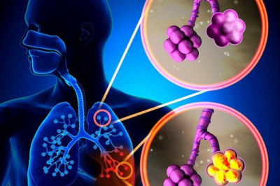 Global Pneumonia Testing Market: Trends, Size, Growth, Opportunity, and Forecast to 2022-2028