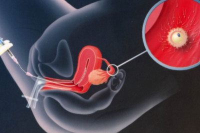 How does Artificial Insemination Work?