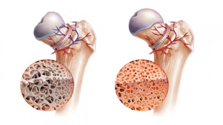 Role of Osteonecrosis Treatment in Managing the Pain and Preserve Your Joint