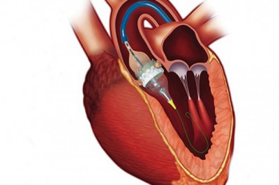 Transcatheter Aortic Valve Implantation (TAVI) Market Proliferating Opportunities, New Innovation, Development, Application Till 2025