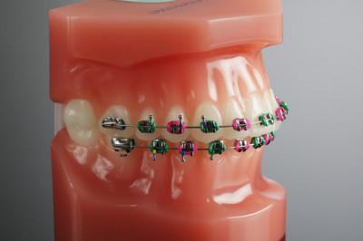 What Are The Best Colors For Dental Braces?