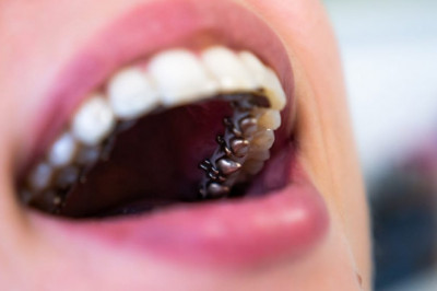 What Are the Upside and Downsides of Braces?