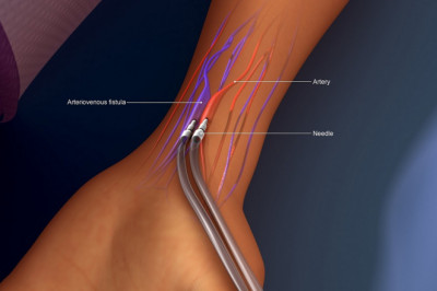 Creating an Arteriovenous Fistula for Hemodialysis