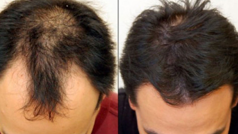 Hair Loss Treatment - The Top 3 Treatments That Actually Work