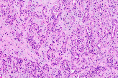 The Slender Tubes That Carry Bile, The Digestive Fluid, Can Develop Cholangiocarcinomas