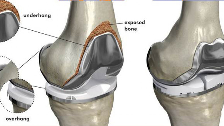 Best knee replacement surgeon in Delhi NCR