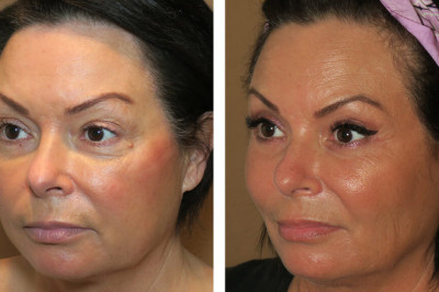 What Should be Your Expectation While Going for Facial Rejuvenation!