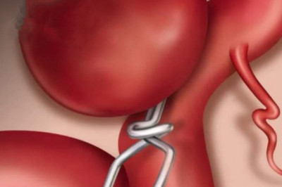 Global Aneurysm Clips Market: Trends, Size, Growth, Opportunity, and Forecast to 2026