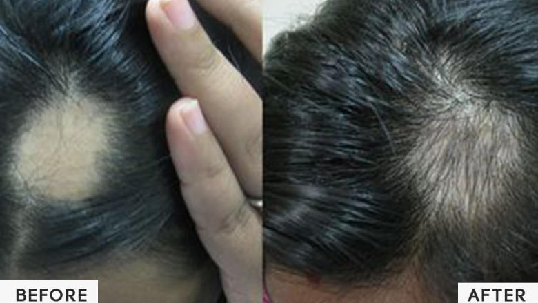 Hair Loss: Myths, Causes and Treatments