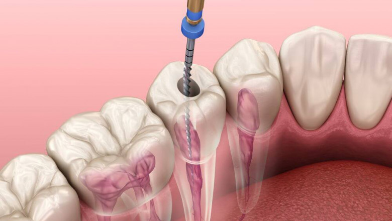 Root Canal Treatment in North York
