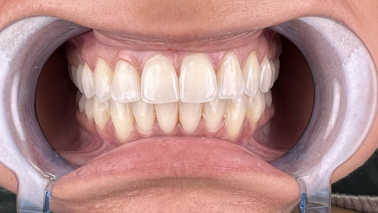 What To Consult With Your Dentist Regarding Dental Implants?