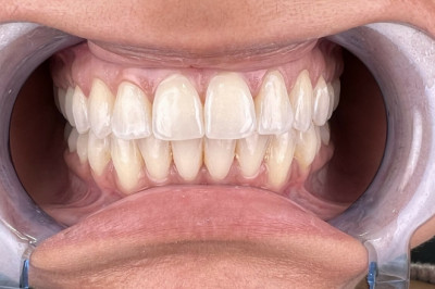 What To Consult With Your Dentist Regarding Dental Implants?