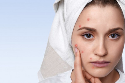 Homeopathy Treatment for Acne