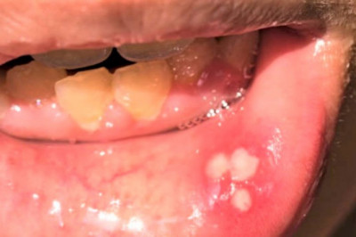 Aphthous Ulcers: Is Autoimmunity Associated with Recurrent Lesions?