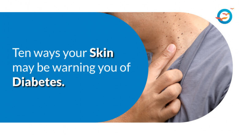 10 Ways Your Skin May Be Warning You of Diabetes
